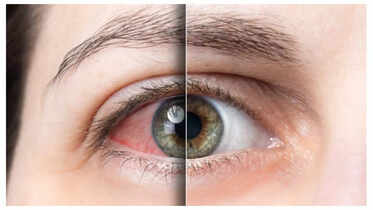 Early Diabetes Symptoms You Can Spot in Your Eyes, Skin, and Legs
