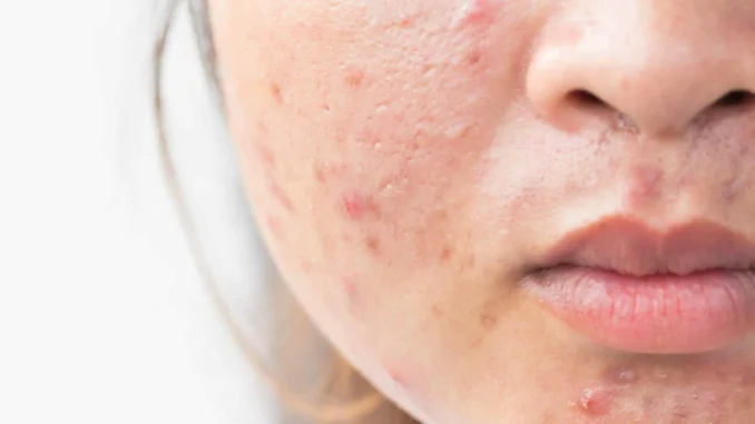 acne-scars-2-min-scaled