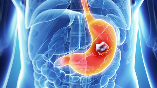 Stomach Cancer Is Deadly: 3 Everyday Foods That May Increase Your Risk