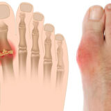 Say Goodbye to Painful Gout Attacks With These Natural Lifestyle Changes