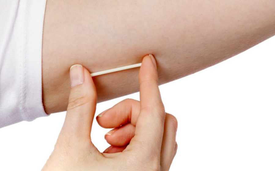 Contraceptive Implant Side Effects: The Hidden Truth You Should Know