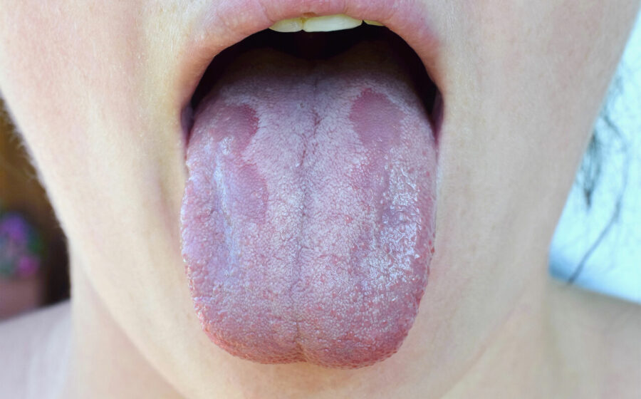If You Notice These Tongue Symptoms, It’s Time to See a Doctor and Consider Testing