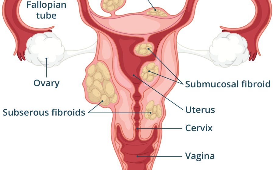 If You Notice These 7 Signs, a Fibroid Could Be in Your Womb