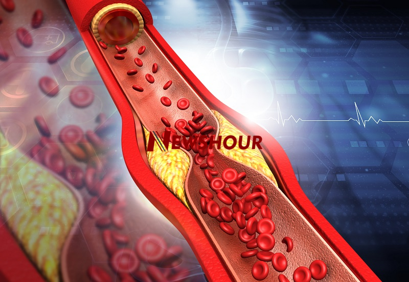 Common Symptoms Of Clogged Arteries Many People Mistake For Minor Problems