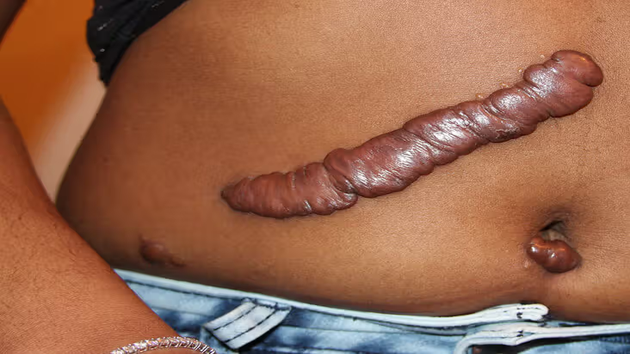 How to Remove Bumps and Keloids Safely Without Surgery