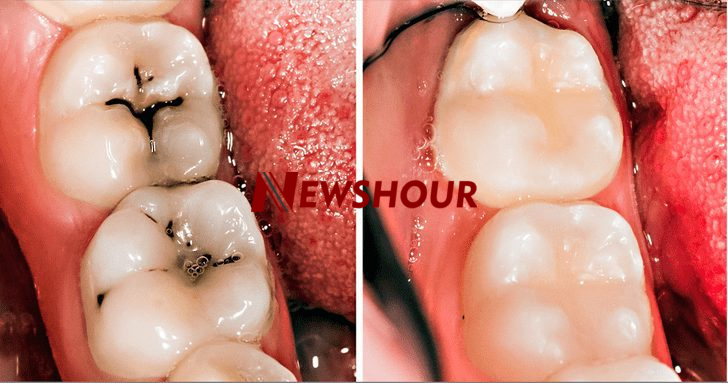 Natural Ways to Keep Tooth Decay from Getting Worse at Home