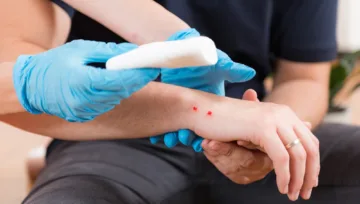 Snake Bite Can Be Deadly: 4 Things You Must Do Immediately After Being Bitten