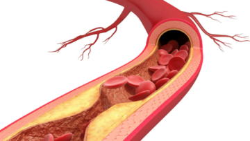 Silent Signs of Clogged Heart Arteries You Must Not Ignore