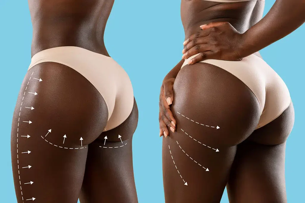 The Dark Side of BBL: How a Brazilian Butt Lift Can Harm Your Body